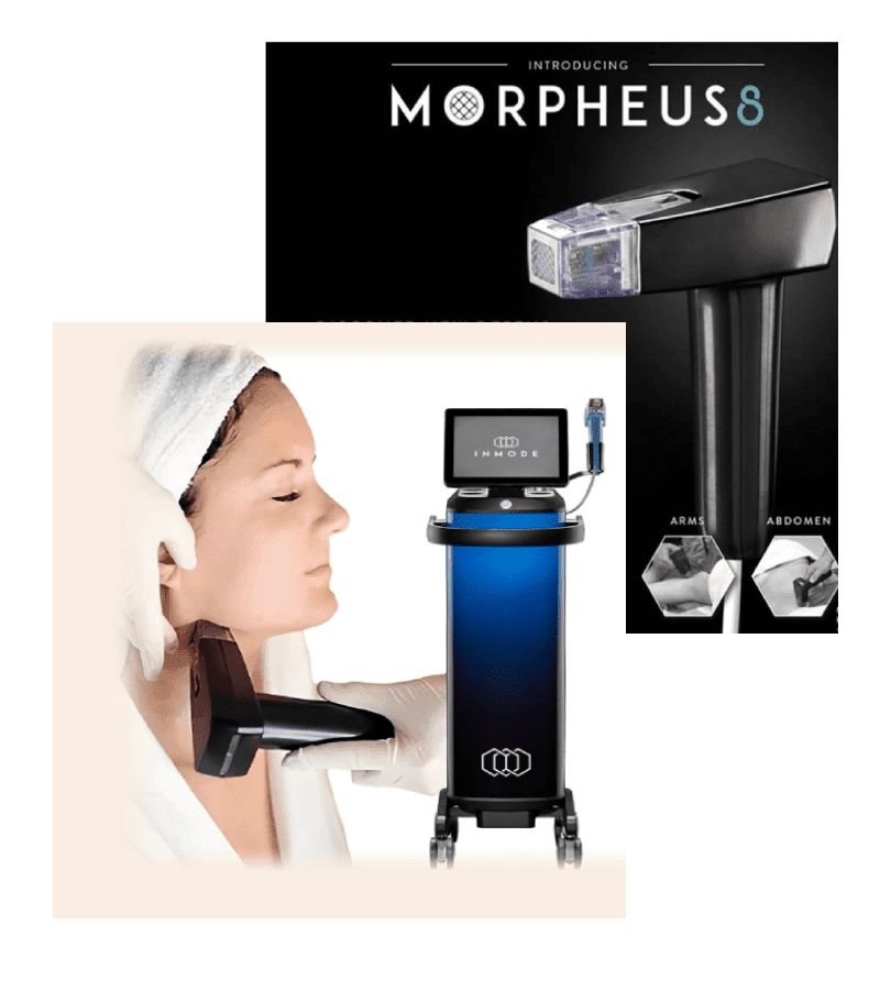 Morpheus Eight Microneedling with Radiofrequency