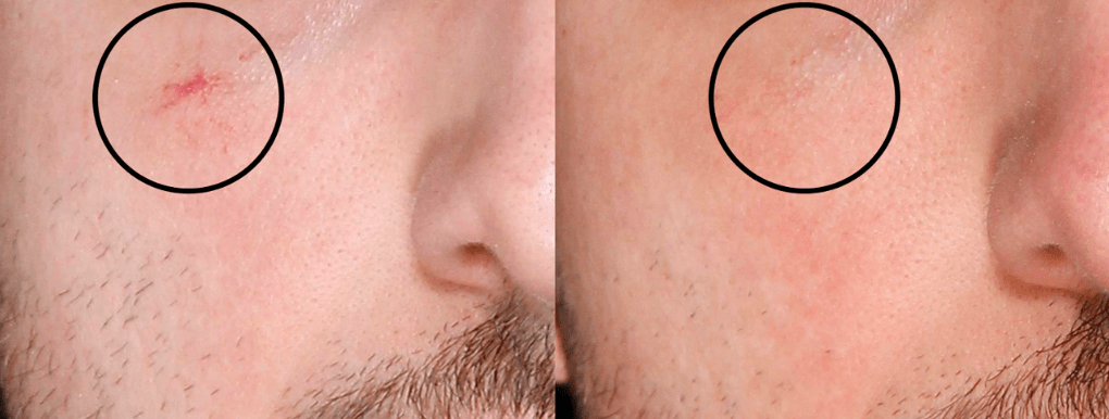 A before and after of a scar visibility