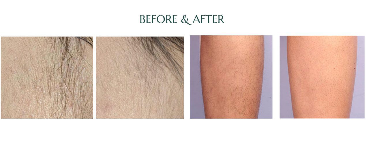 A before and after picture of hair removal.