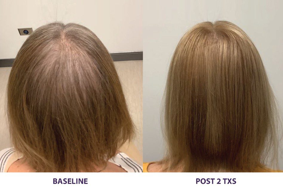 A before and after picture of the hair growth process.